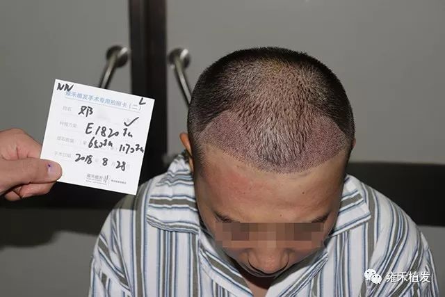 长沙男子植发近9个月后惊现反光现象，后脑勺竟如狗啃过？揭秘背后的故事与真相！