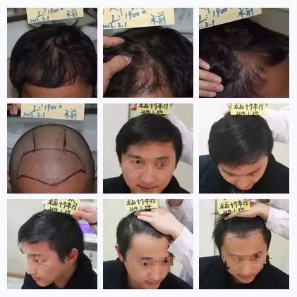 晨意帮忙，男子植发近九个月的神奇经历——后脑勺的反光之谜